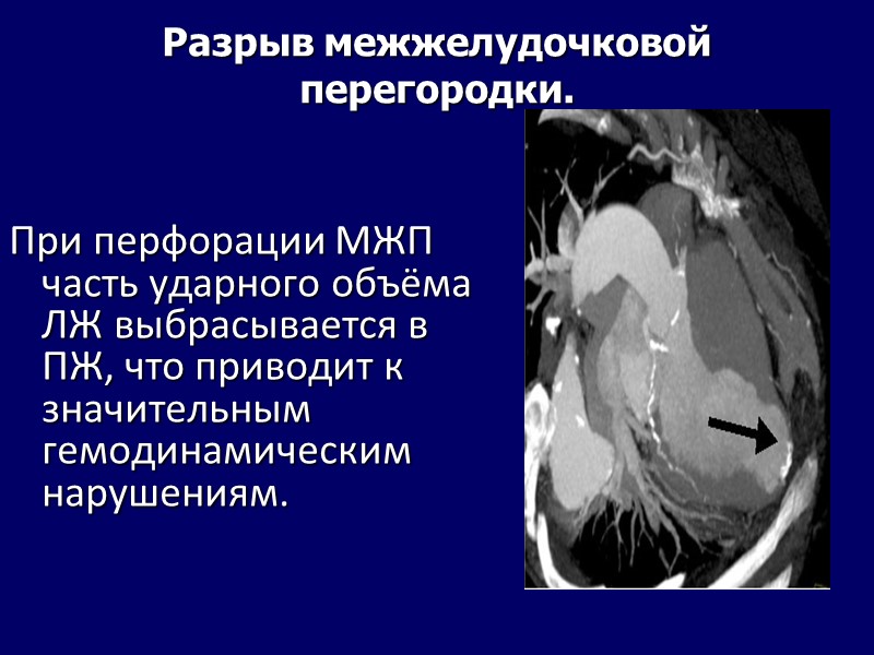 Разрыв межжелудочковой перегородки. При перфорации МЖП часть ударного объёма ЛЖ выбрасывается в Разрыв межжелудочковой перегородки. При перфорации МЖП часть ударного объёма ЛЖ выбрасывается в